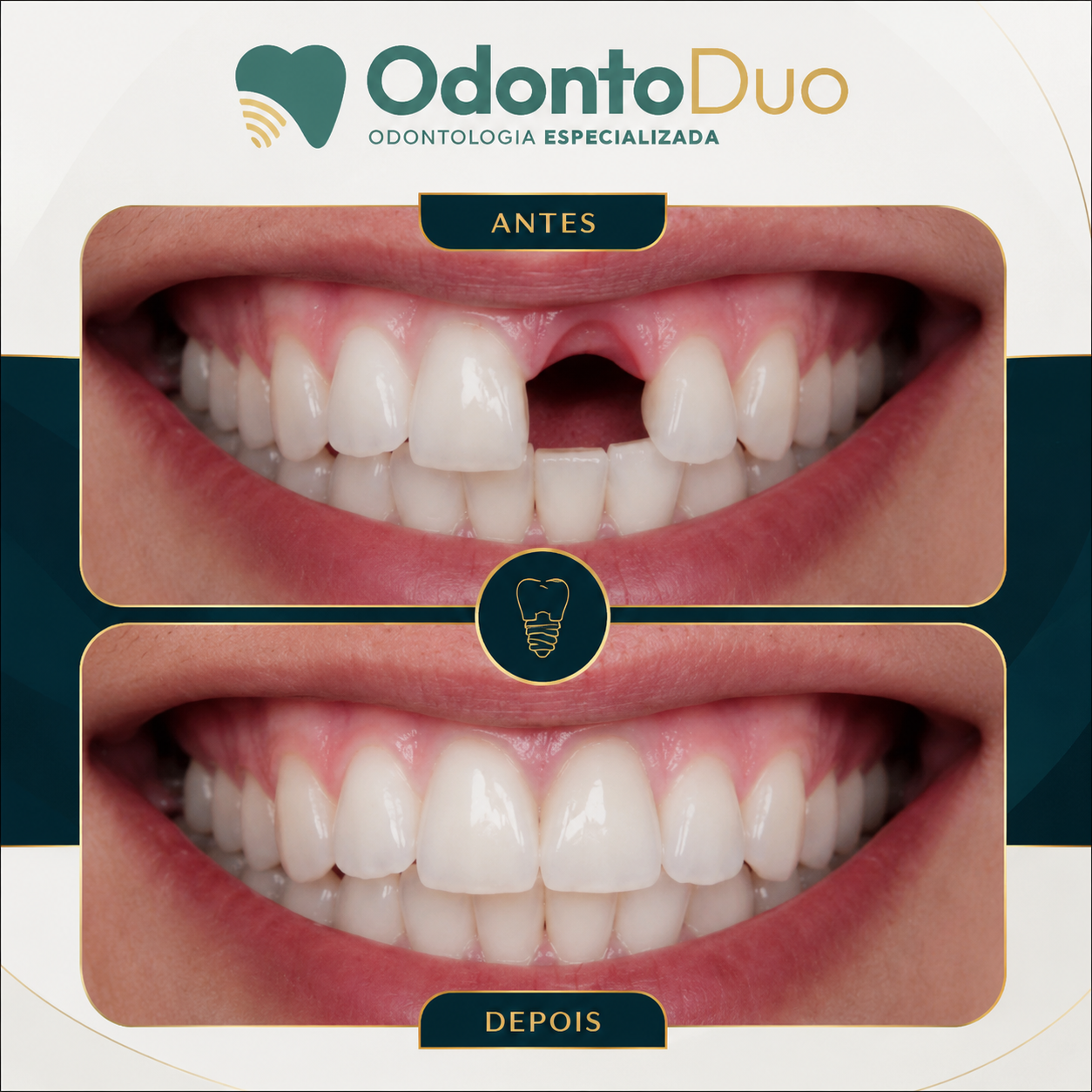 Caso 1 — Reabilitação de dente ausente